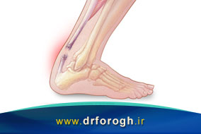 از علت و علائم تا درمان آسیب تاندون آشیل پا