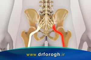درمان درد سیاتیک با روشهای غیر جراحی
