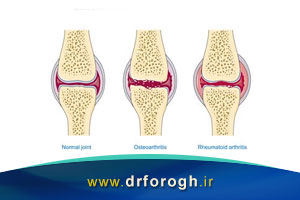 تعریف بیماری های روماتیسمی و التهاب مفاصل