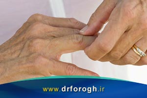 آیا شکستن قولنج انگشتان دست باعث آرتروز می شود؟