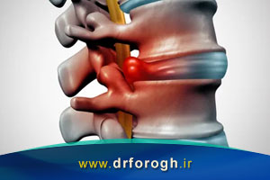 بهترین روشهای درمان دیسک کمر بدون جراحی