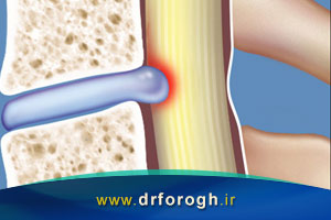 علت تنگی کانال مهره ای و درمان آن با لیزر