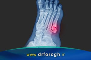 متاتارس یا شکستگی استخوان کف پا از علل تا روشهای درمان
