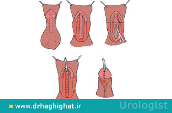 مراحل انجام و هزینه عمل جراحی ترمیم هیپوسپادیازیس