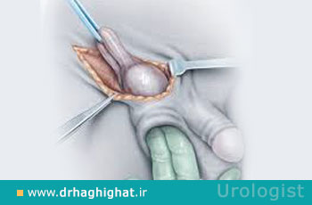 عمل جراحی ارکیکتومی برای درمان سرطان بیضه