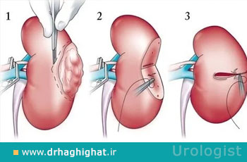 نفرکتومی چیست؛ آشنایی با جراحی برداشتن کلیه و انواع آن