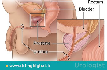بیوپسی پروستات؛ انواع، روشها و نحوه نمونه برداری از پروستات