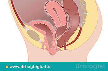 سیستوسل (افتادگی مثانه)؛ علائم، تشخیص و عمل جراحی سیستوسل