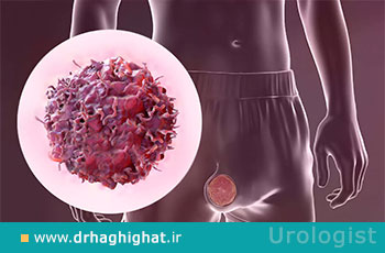 اپیدیدیمیت (عفونت بیضه)؛ علت، علائم و درمان اپیدیدیمیت حاد و مزمن