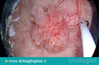 تومور مثانه؛ علائم، تشخیص و جراحی تومور مثانه + مراقبت های بعد از عمل