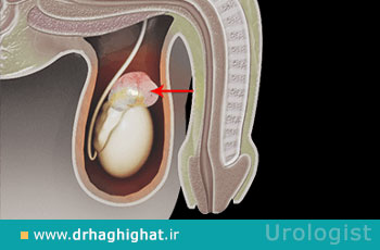 اسپرماتوسل؛ علت، علائم و درمان اسپرماتوسل + عکس اسپرماتوسل