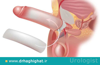بزرگ کننده آلت؛ روشهای علمی افزایش سایز آلت تناسلی مردان