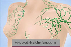 ارتباط غدد لنفاوی و سرطان پستان