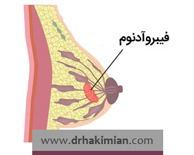 آیا فیبروادنوم خطرناک است؟