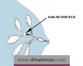 گالاکتوسل چیست؟