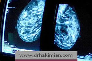کدام زنان در معرض سرطان سینه هستند؟