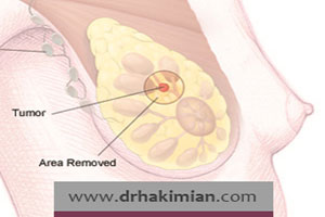 مقایسه جراحی لامپکتومی و ماستکتومی پستان