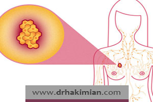 سرطان سینه متاستاتیک چیست؟