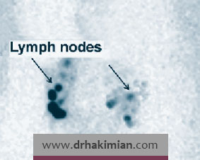 تصویربرداری مجاری و غدد لنفاوی (لنفوسیتی گرافی) چیست؟