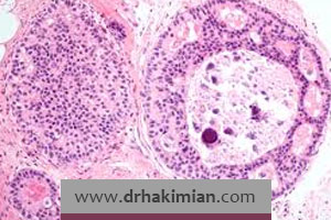 کارسینوم داکت های شیری (DCIS) یا سرطان سینه غیرتهاجمی چیست؟