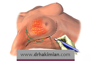 در چه افرادی ماستکتومی برای پیشگیری از سرطان سینه انجام می شود؟