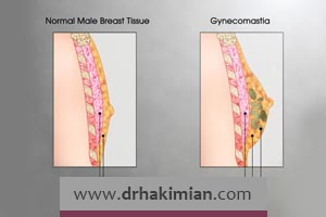 چه عواملی باعث بروز ژنیکوماستی می شوند؟