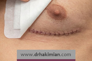 آشنایی با عوارض بعد از عمل ژنیکوماستی