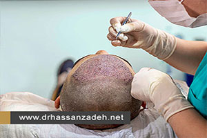 کاشت مو به روش FIT چه معایب و مزایایی دارد؟