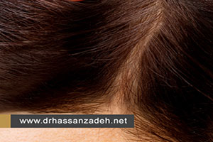 درمان ریزش مو با داروی فیناستراید( پروپشیا)