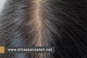 علت و درمان ریزش موی ناگهانی شدید یا تلوژن افلوویوم