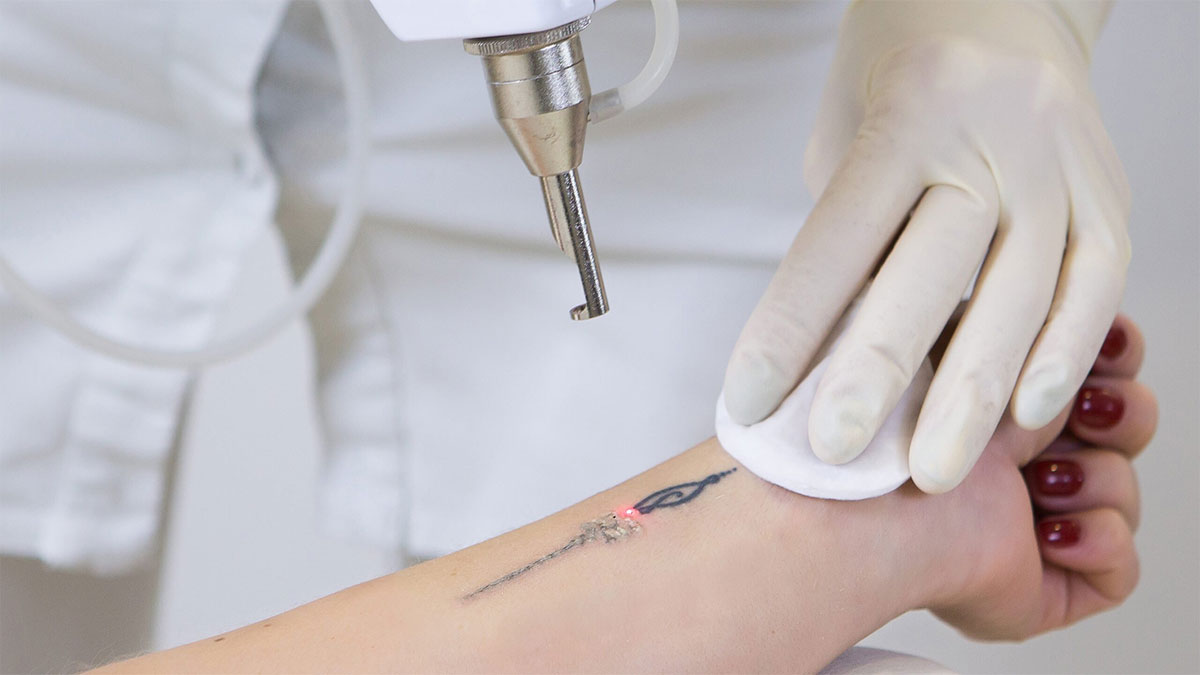 لیزر تاتو با روش های ترکیبی و آخرین متدهای 2025 توسط پزشک متخصص
