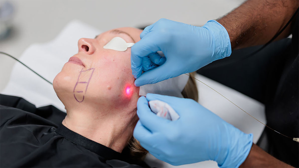 اندولیفت در اصفهان | مراحل انجام، مراقبت ها و هزینه اندولیفت