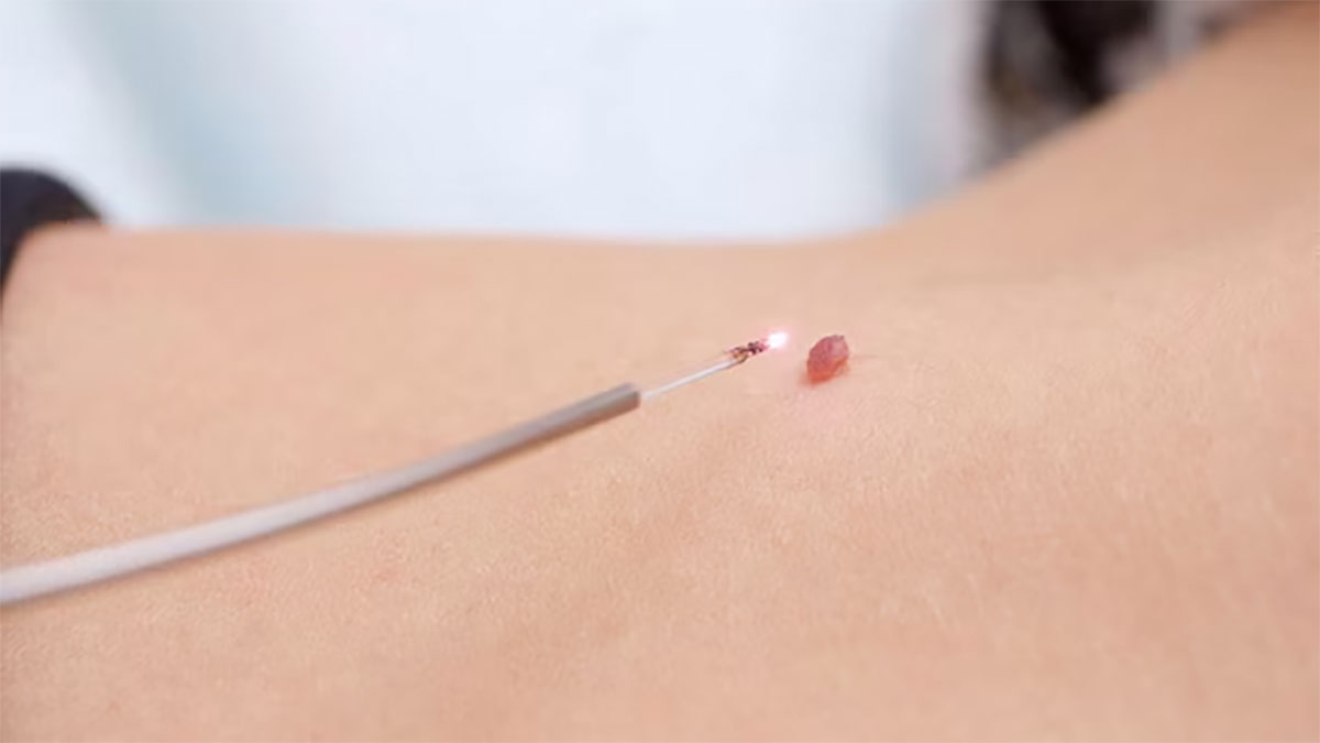 برداشتن خال با لیزر توسط پزشک متخصص و با جدیدترین متدهای 2025