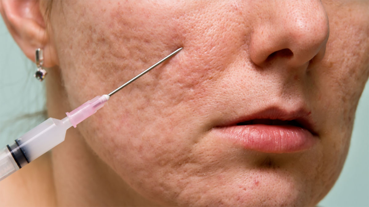 سابسیژن پوست | خدمات سابسیژن برای بهبود بافت و ظاهر پوست در اصفهان