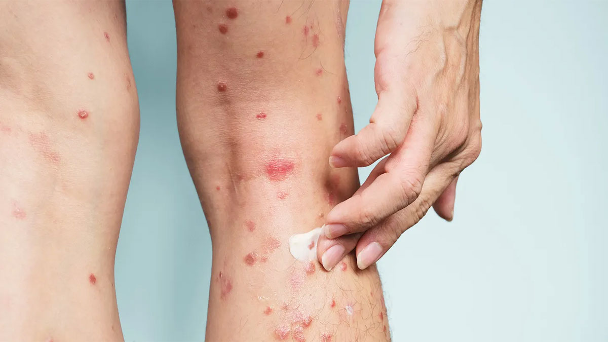 درمان پسوریازیس خفیف، متوسط و شدید با دارو و لیزر درمانی