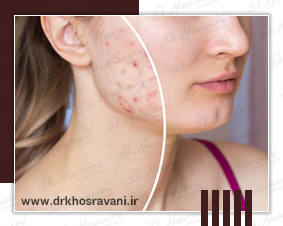 پانچ صورت؛ بهترین روش درمان جای جوش عمیق