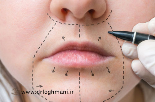 مراقبت های بعد از لیفت سانترال لب؛ راهنمای کامل دوران نقاهت