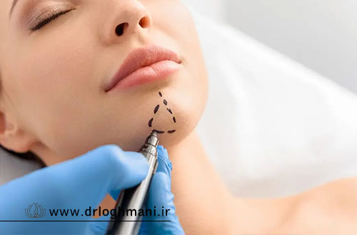 پروتز چانه یا جنیوپلاستی؟ مقایسه نتایج، ماندگاری و هزینه