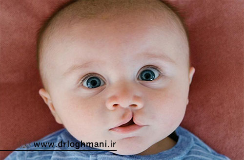 مراقبت های بعد از عمل شکاف کام؛ از بخیه تا حرف زدن و تغذیه پس از جراحی
