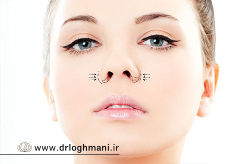 آلارپلاستی بینی؛ جراحی اصلاح پره های بینی و کوچک کردن سوراخ ها