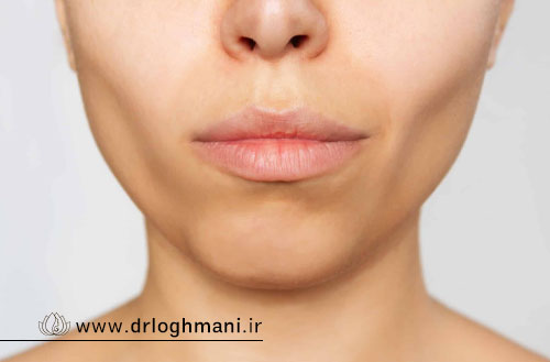 ماندگاری بوکال فت؛ آیا بوکال فت بازگشت دارد یا نتیجه آن دائمی است؟