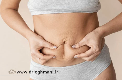 عوارض ابدومینوپلاستی؛ خطرات، مشکلات پس از عمل و عوارض بلندمدت