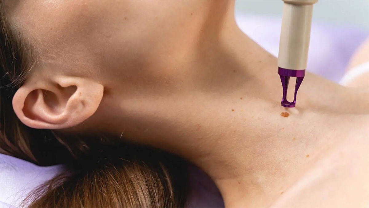 مراحل و هزینه برداشتن خال با آر اف سرجیکال ؛ کلینیک تخصصی دکتر حداد