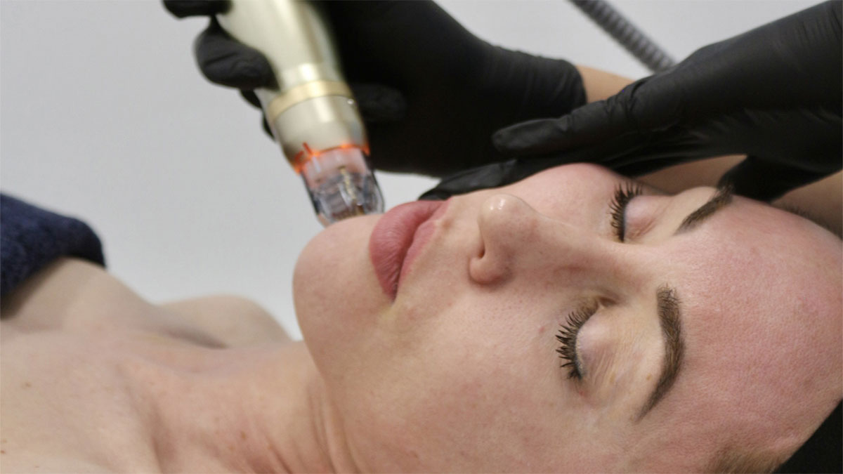 آر اف فرکشنال؛ عکس قبل و بعد آر اف فرکشنال و قیمت و تعداد جلسات