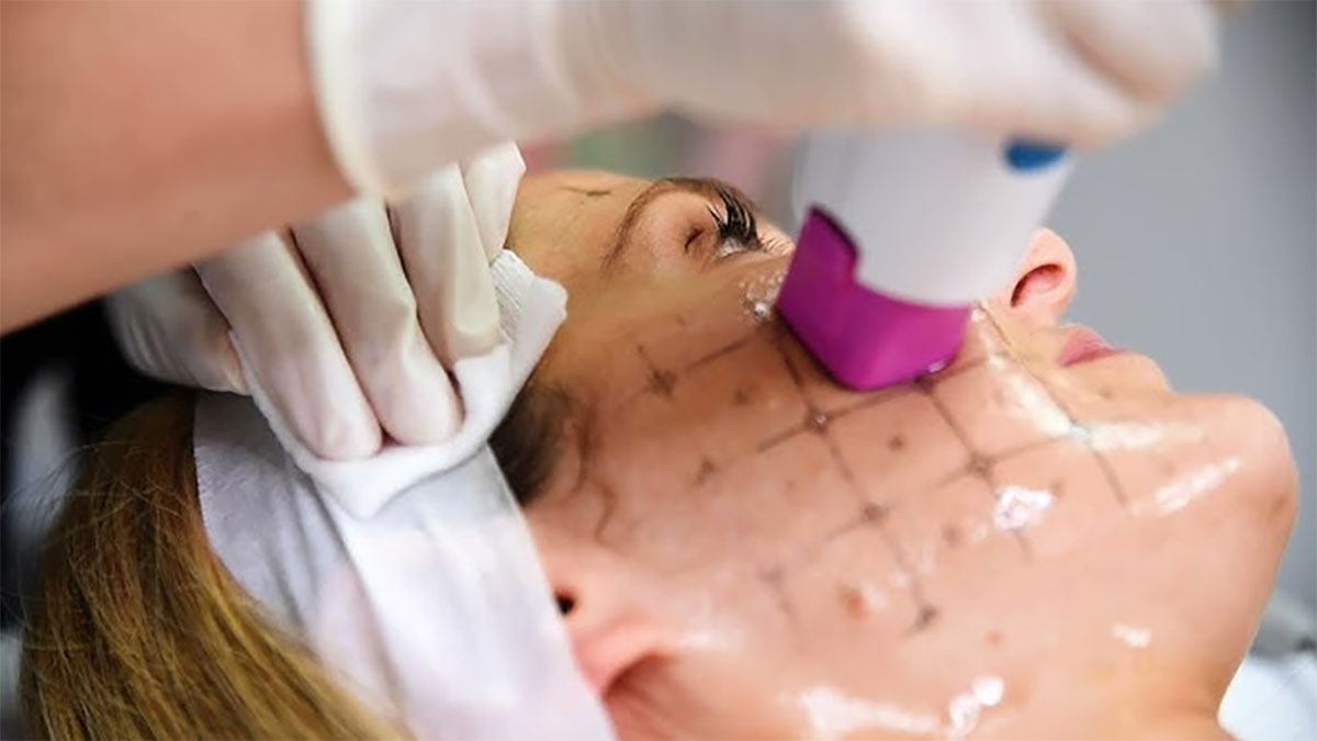 آر اف ترماژ در اصفهان؛ بهترین روش لیفت و کلاژن سازی پوست با آر اف ترماژ صورت