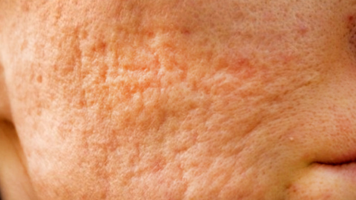 سابسیژن صورت در اصفهان | پوستی صاف و یکدست با روش تخصصی دکتر حداد