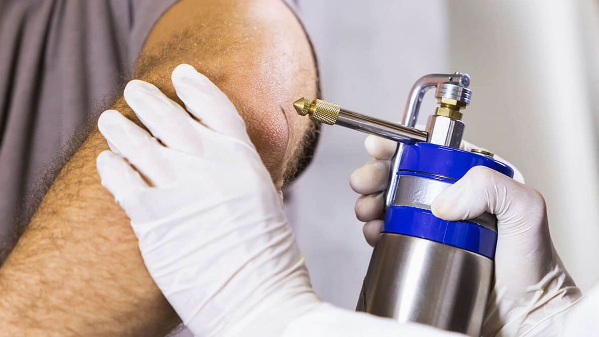 کرایوتراپی در اصفهان | درمان سریع و کم عارضه ضایعات پوستی