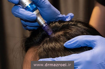 همه چیز درباره میکرونیدلینگ مو؛ مزایا، مراحل و هزینه
