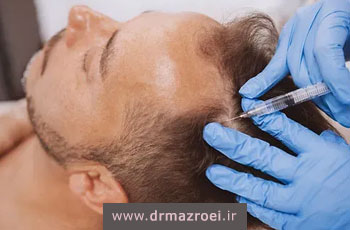 مزونیدلینگ مو؛ درمان تخصصی ریزش و تحریک رشد مجدد مو