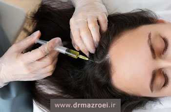 عوارض مزونیدلینگ مو و راه های پیشگیری از آن ها